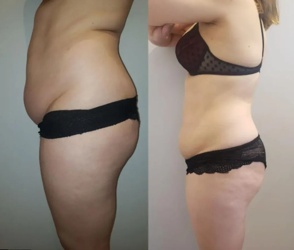 Foto de antes e depois da criomodelagem de placas no corpo feminino, mostrando redução de medidas abdominais e melhora do contorno.