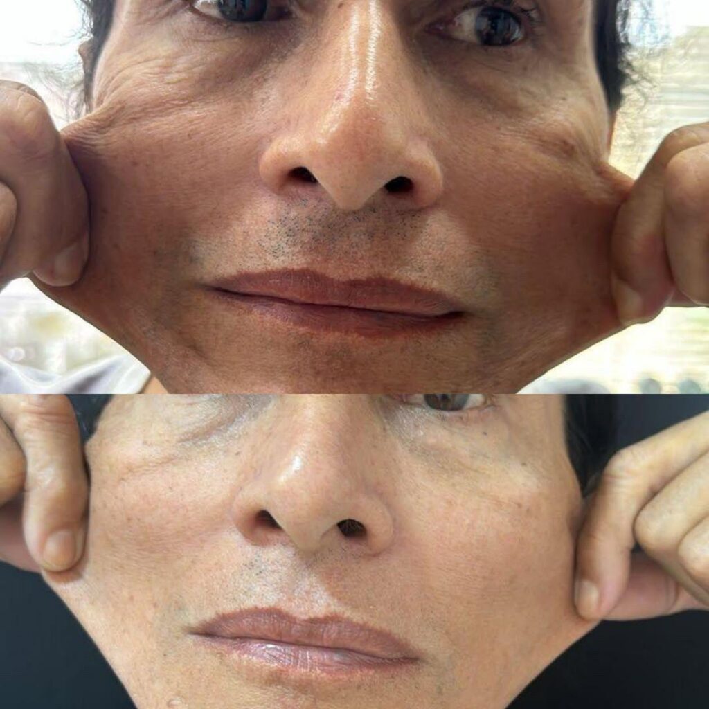 rosto de mulher de antes e depois do procedimento de bioestimulador de colágeno.