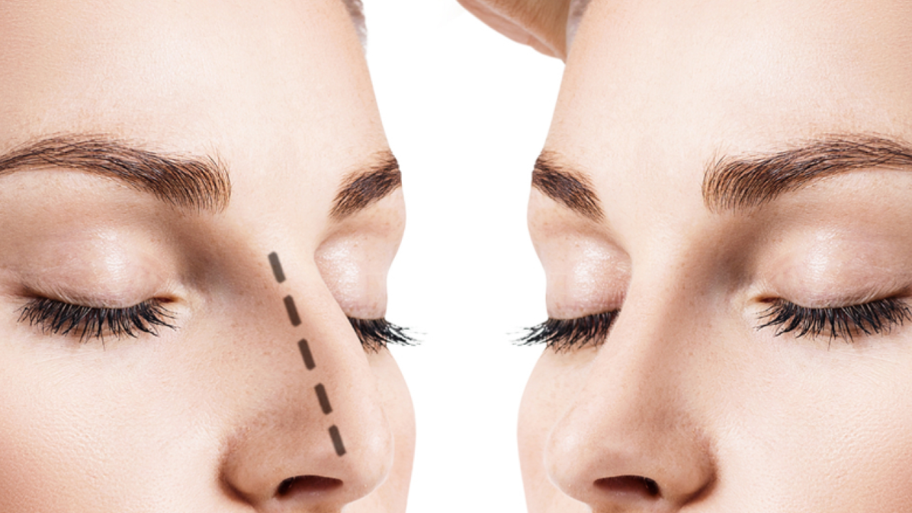 Nariz Empinado no Natal? O Prazo Limite da Rinomodelação