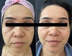 Bioestimulador de colágeno Rosto + Papada!! A fonte da juventude está aqui, evolução de 40 dias dessa paciente e ainda irá evoluir muito mais, reparem o quanto retraiu a flacidez. Os bioestimuladores