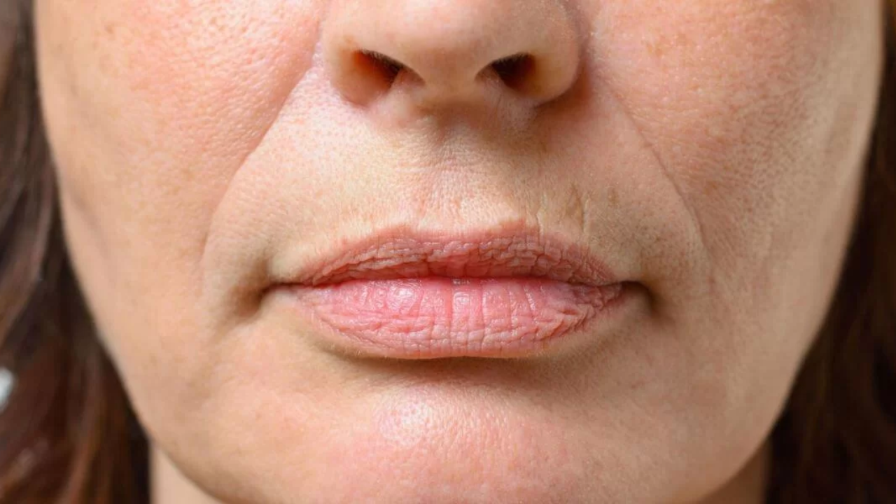 Bigode Chinês e Bochechas Caídas: A Causa Real da Flacidez